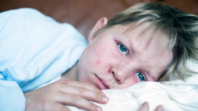 Supplement industry sets record straight on cod liver oil for measles